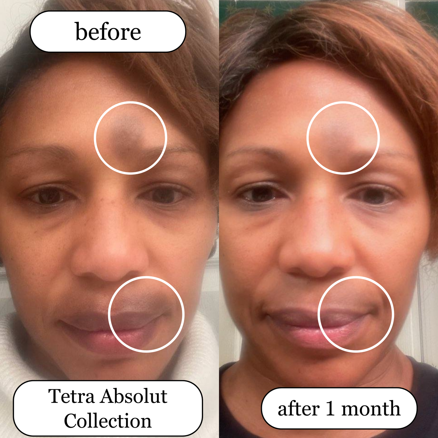 Tetra Absolut Full Set Before and After